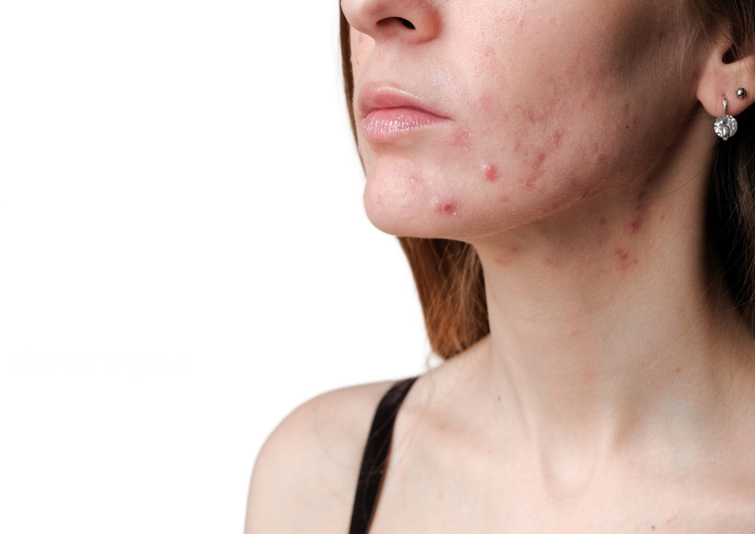 Salicylic Acid 30% - Image 3