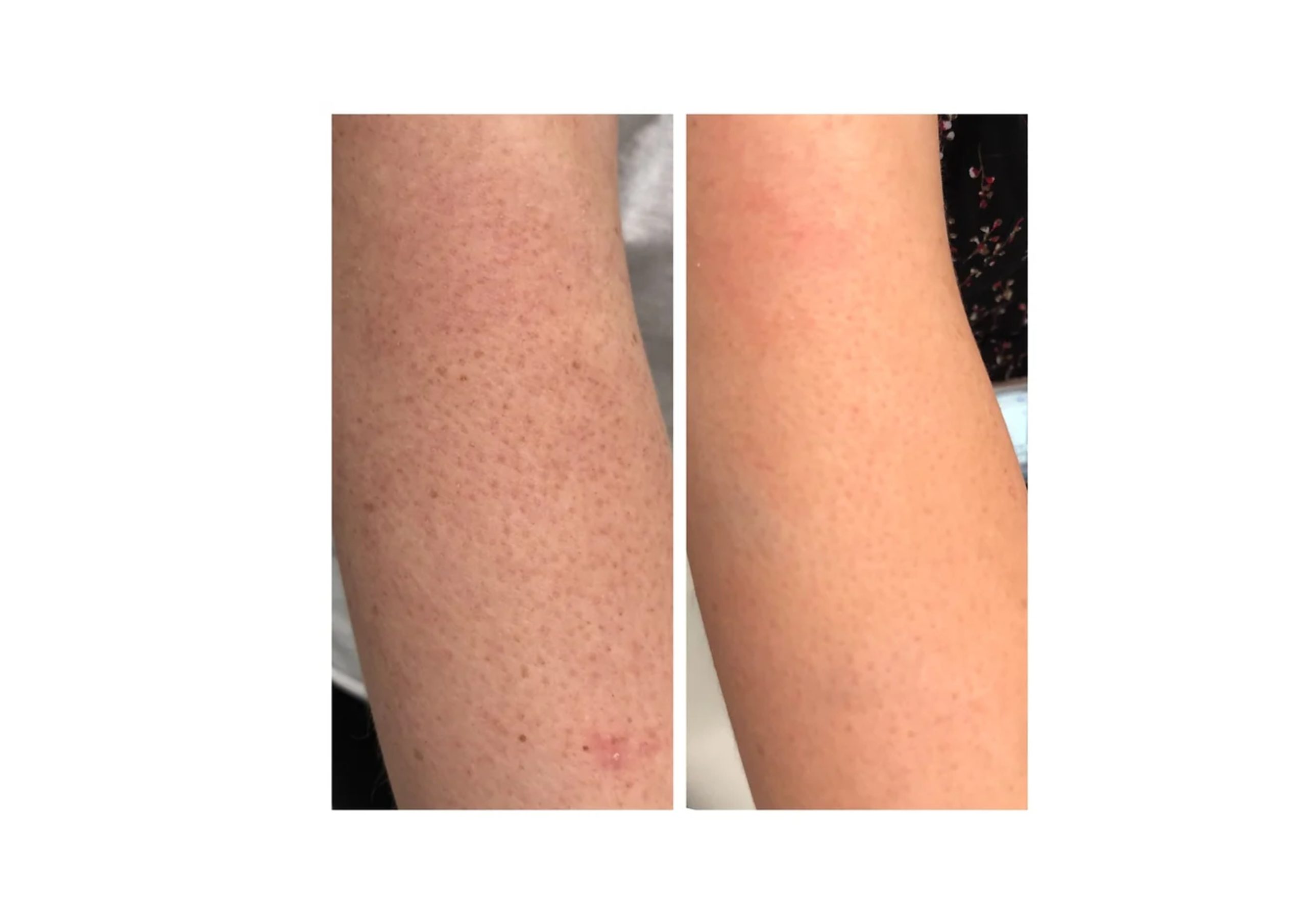 Purple Peel 25 - Image 4